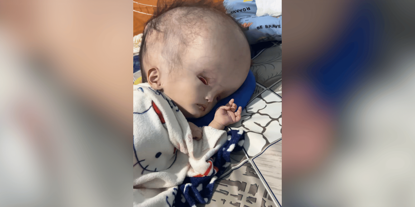 Help My Baby Beat Hydrocephalus