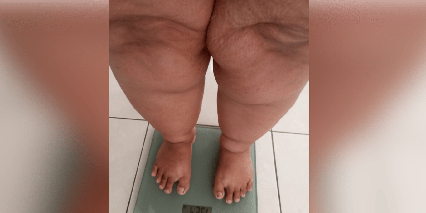 Please Help Me Get Bariatric Surgery and Rebuild My Life
