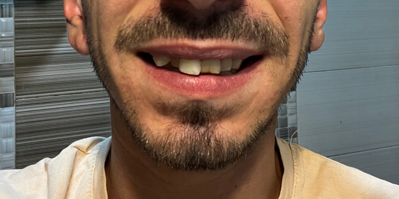 A Journey to Rediscover My Smile