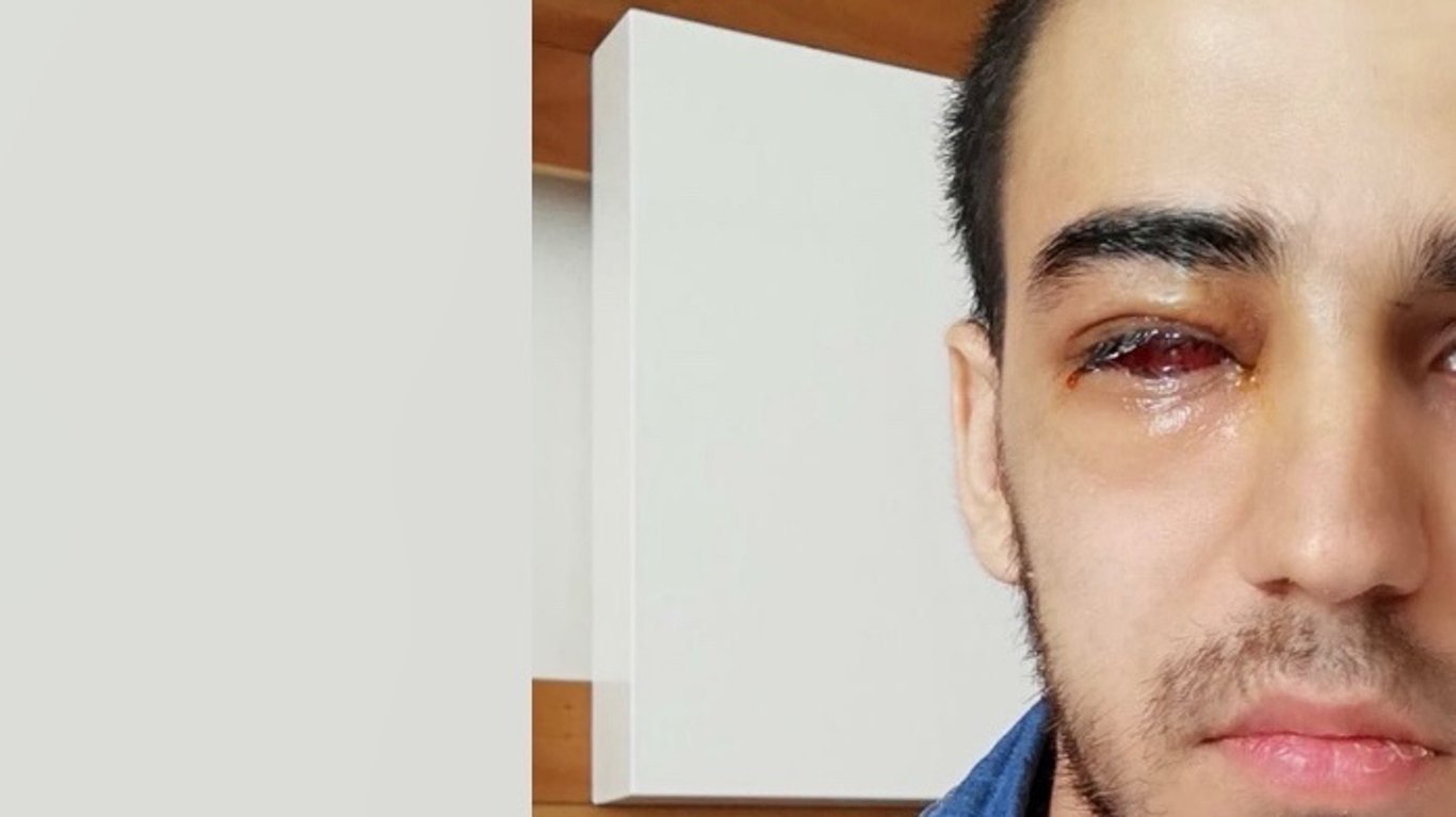 Help Me Rebuild My Life After Losing an Eye in a Devastating Accident