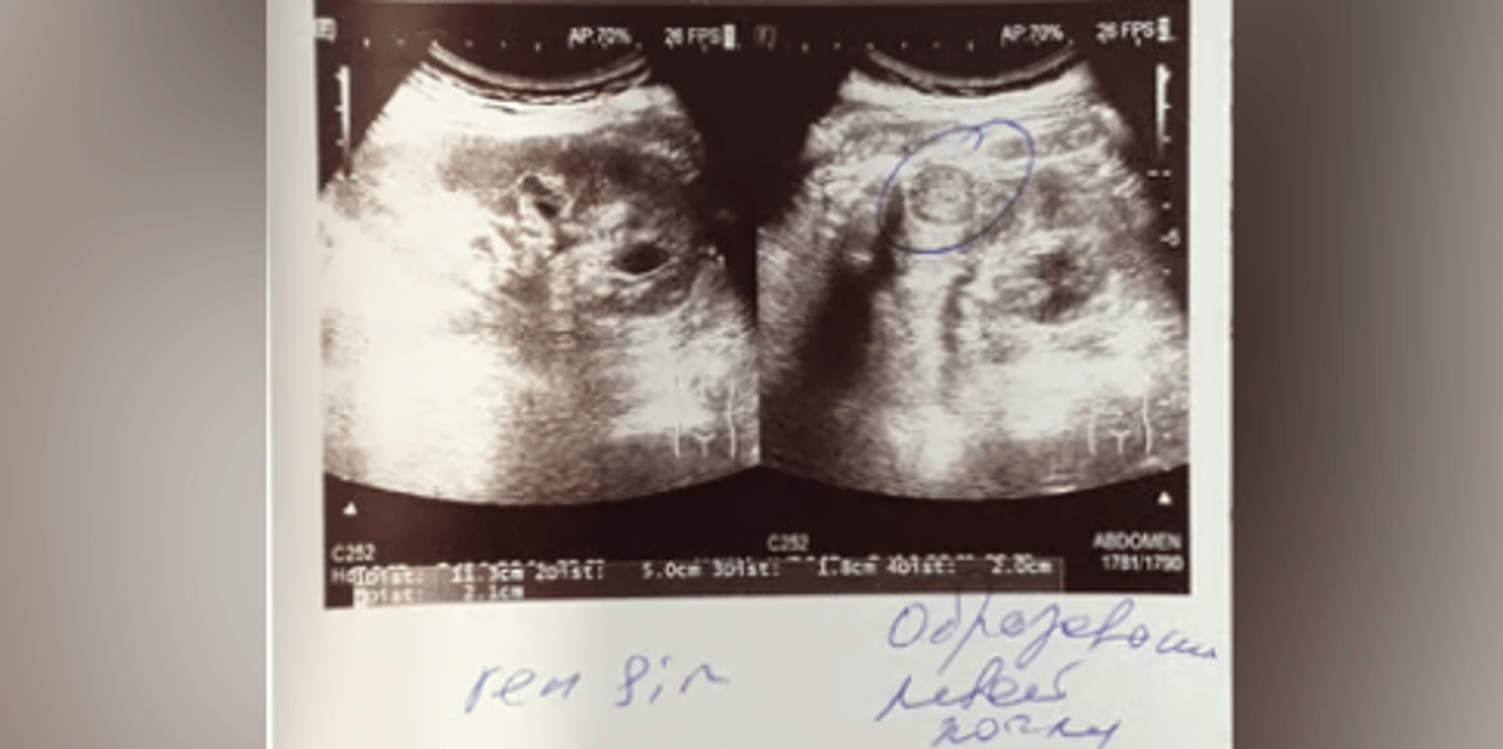Our mother is fighting kidney cancer
