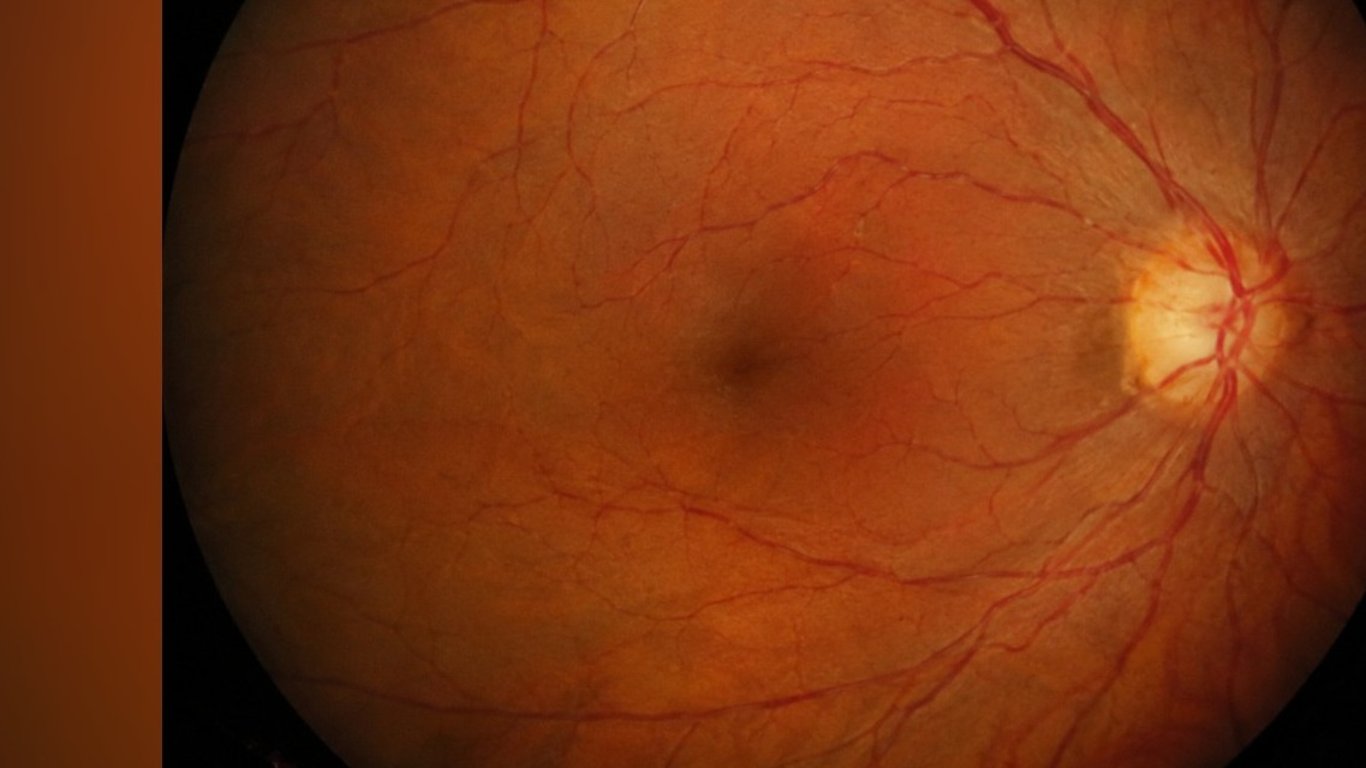 Help Omar Protect His Vision Before It’s Too Late