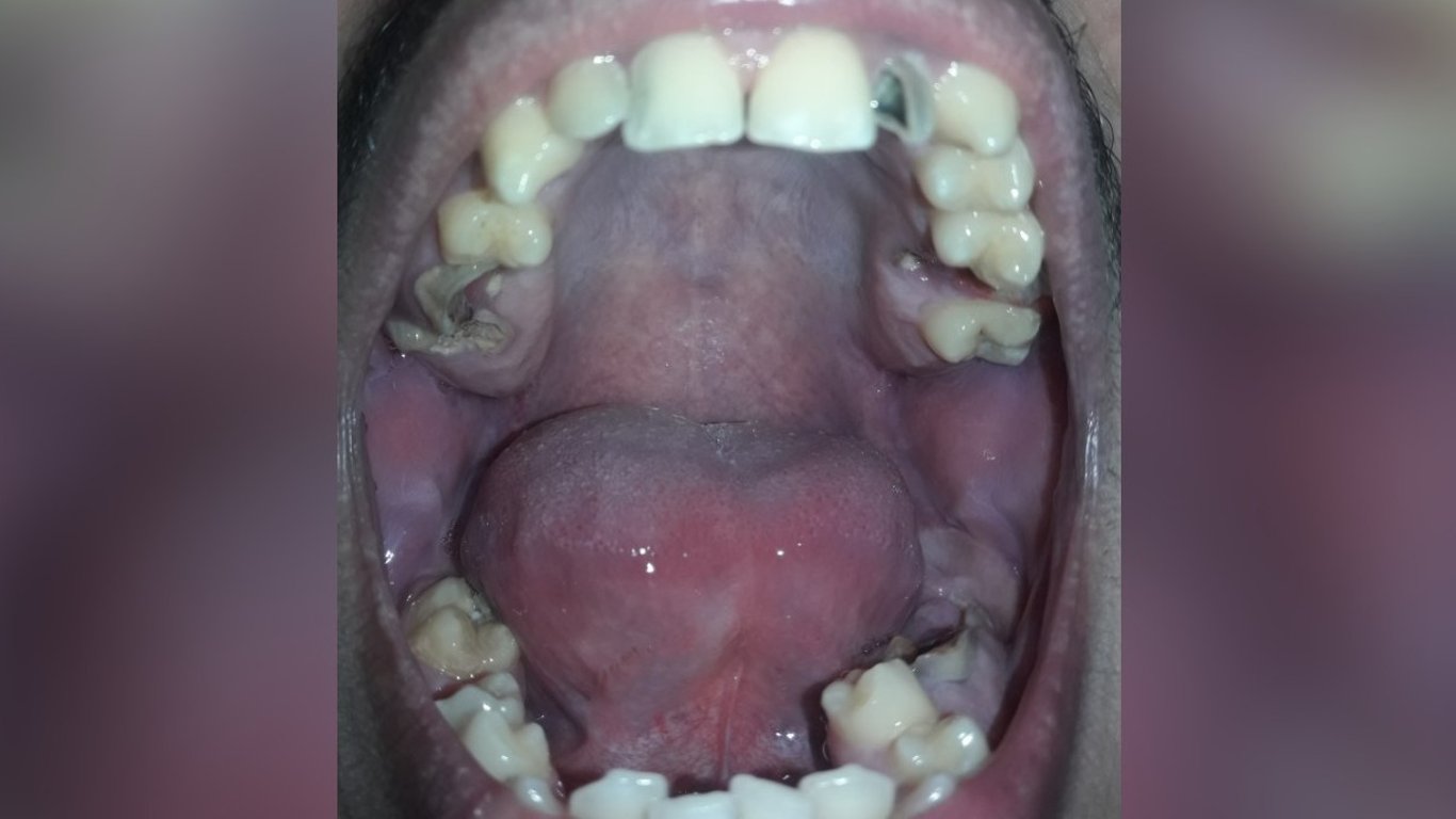 Help Me Restore My Teeth and Smile Again
