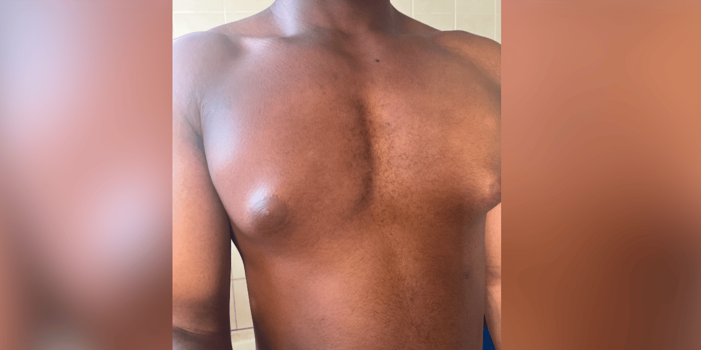 Help raise money for a gynecomastia surgery