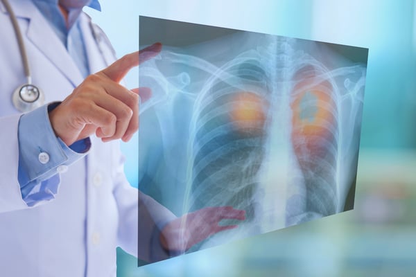 Insamling för Hjärt-Lungfonden: Din Kompletta Guide 2 hjärt och lungfonden